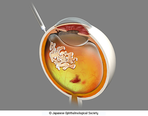 © Japanese Ophthalmological Society