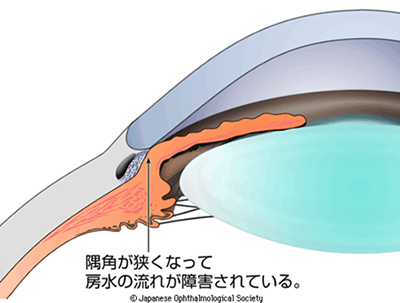 図2：閉塞隅角緑内障