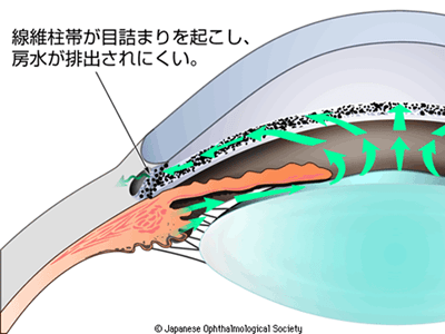 図3:開放隅角緑内障