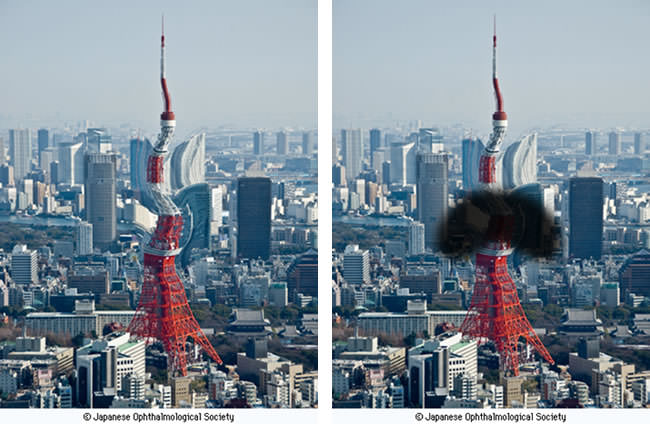 © Japanese Ophthalmological Society